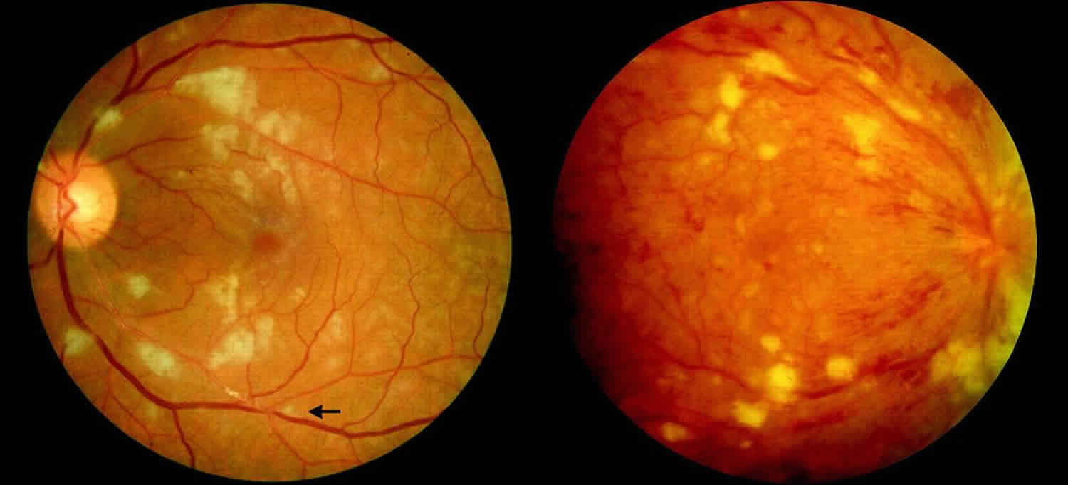 Bagaimana hepatitis B mempengaruhi mata anda