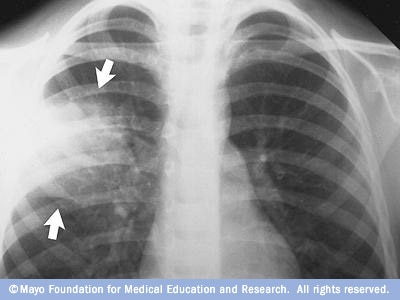 Imej sinar-X paru-paru dengan radang paru-paru