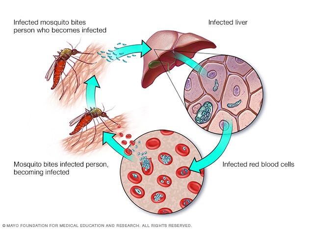 Malaria: sebab, gejala dan rawatan