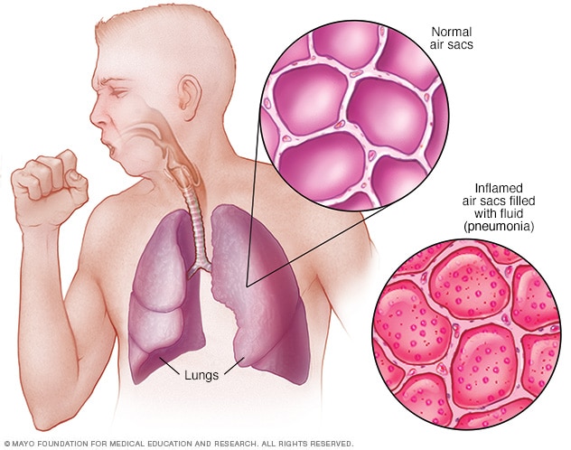 Pneumonia: sebab, gejala dan rawatan