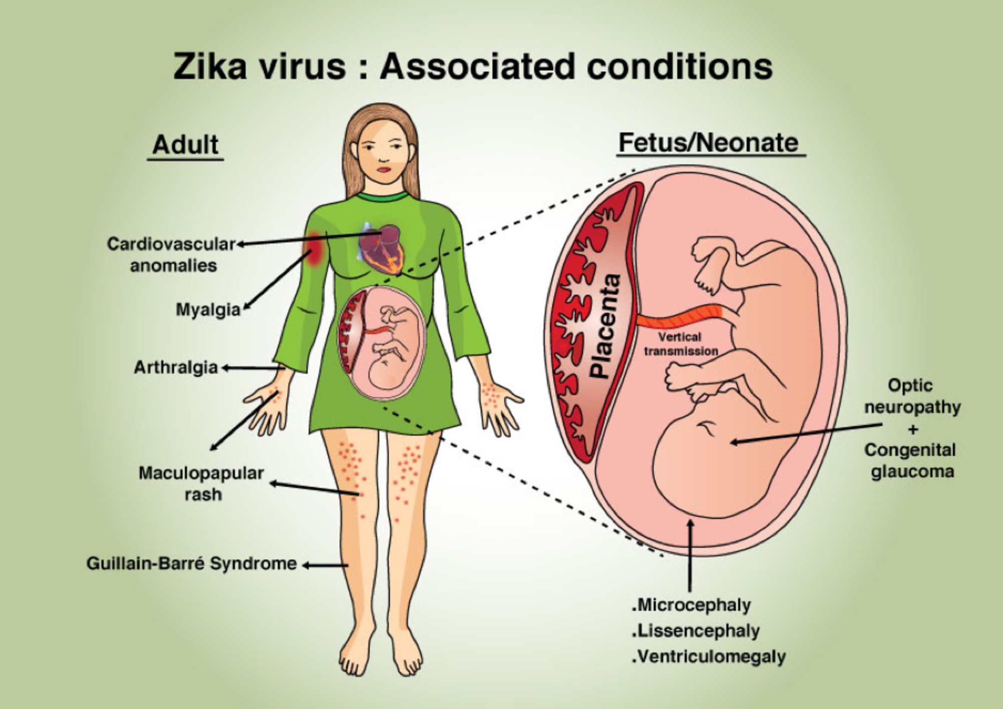 Komplikasi dari jangkitan virus Zika