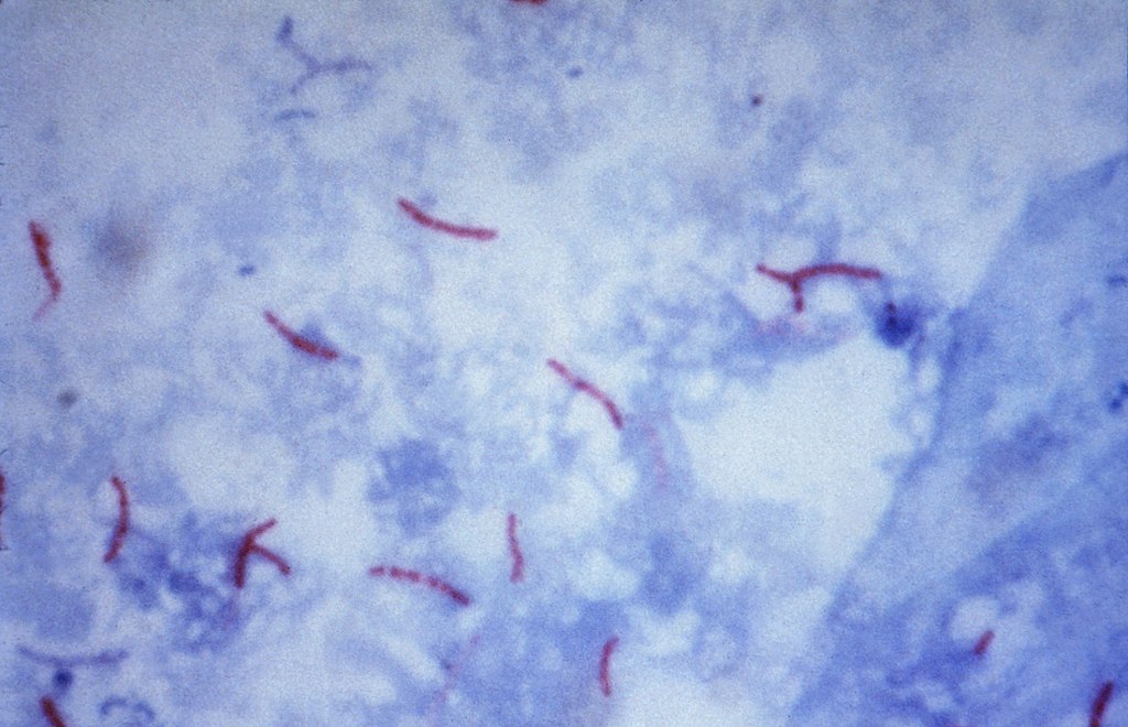 Mycobacterium tuberculosis Ziehl-Neelsen noda 02.jpg