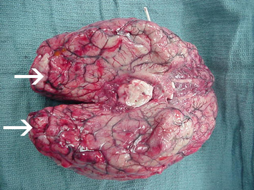 Pendarahan dan nekrosis yang meluas terdapat di otak, terutamanya di korteks frontal.