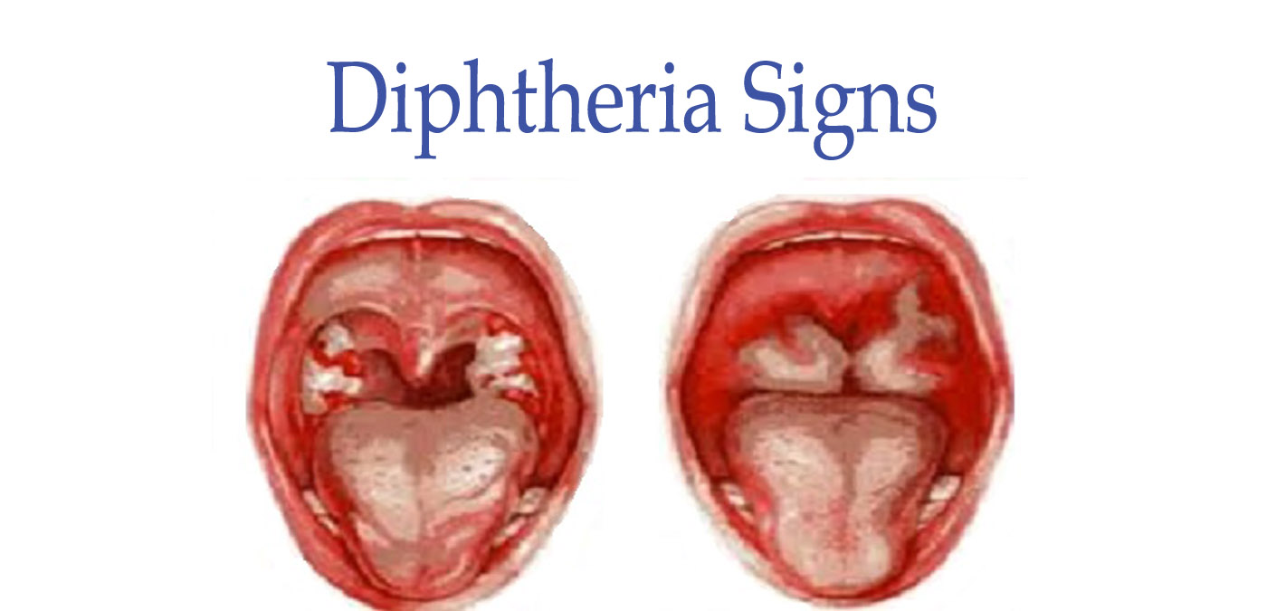 Difteria: sebab, gejala dan rawatan