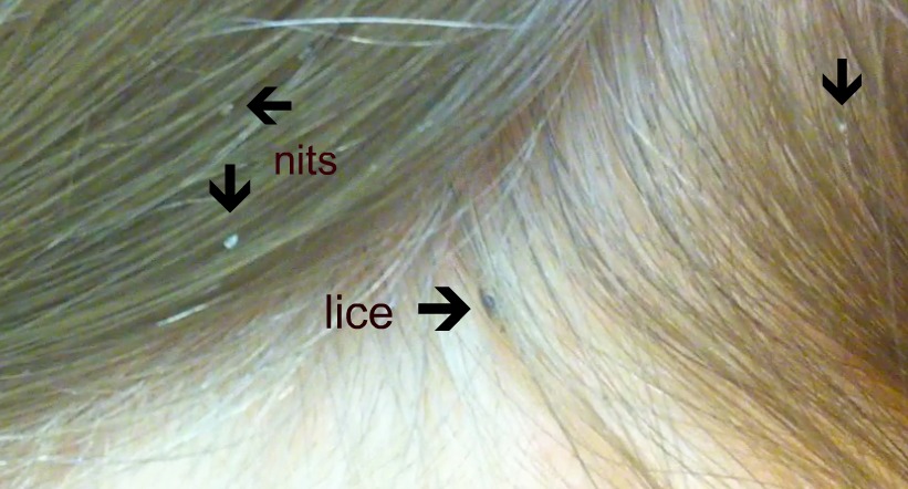 https://medmalay.com/wp-content/uploads/2020/12/head-lice-actual.jpg