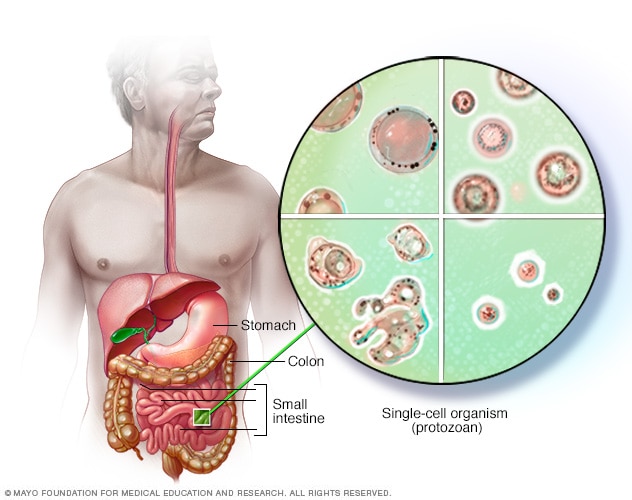 Blastocystis hominis - penyebab, gejala dan rawatan
