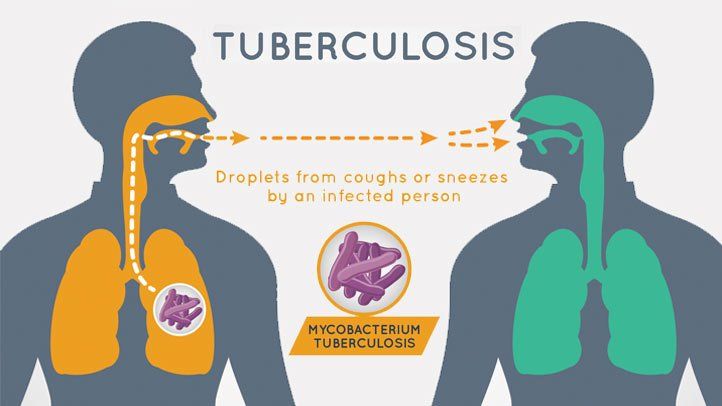 Tuberkulosis: penyebab, gejala dan rawatan